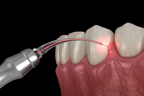 How Laser Dentistry Is Used To Reshape Gums